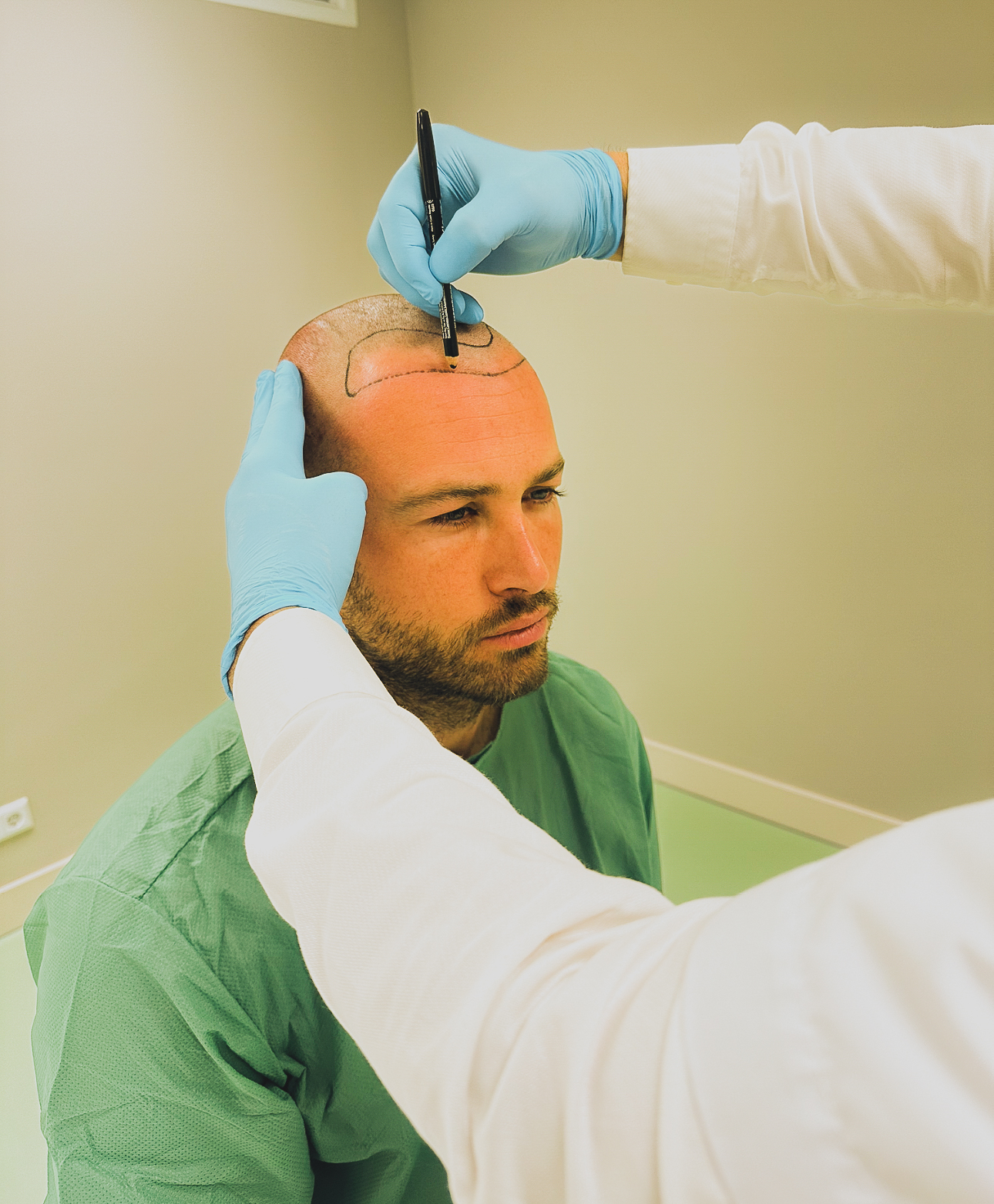 Dave-roelvink-haartransplantatie-ahi-amsterdam